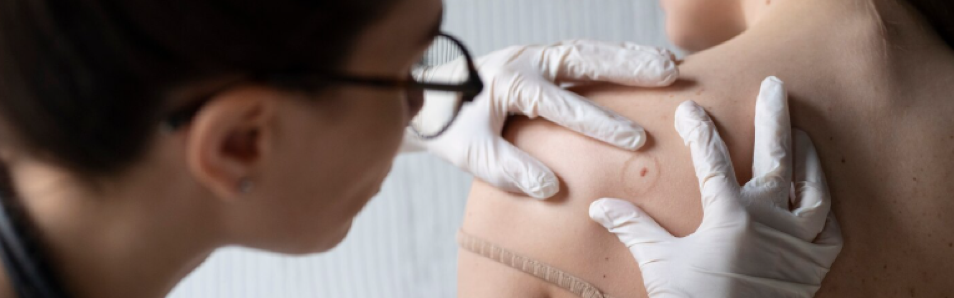 Anyajegyvizsgálat dermatoszkóppal