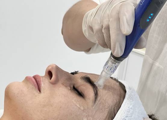 A SkinPen mikrotűs eljárás a bőröd természetes megújulásáért