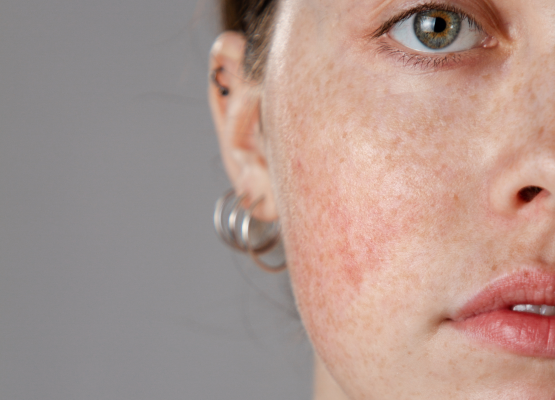 Rosacea kezelése Vár Medical-ban – kíméletes megoldások érzékeny bőrre