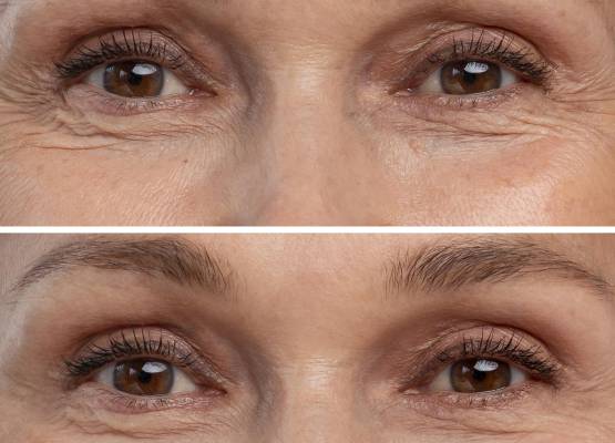 Ráncok a szem alatt: mitől alakulnak ki és mit lehet velük kezdeni?