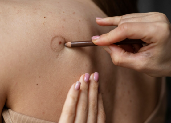 Életmentő pontosság: miért elengedhetetlen a dermatoszkópos anyajegyszűrés? Életmentő pontosság: miért elengedhetetlen a dermatoszkópos anyajegyszűrés?